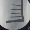 O echipă de medici de ortopedie și traumatologie a operat, în această dimineață, o pacientă de 73 de ani, din Ucraina, care suferise fractură de femur!